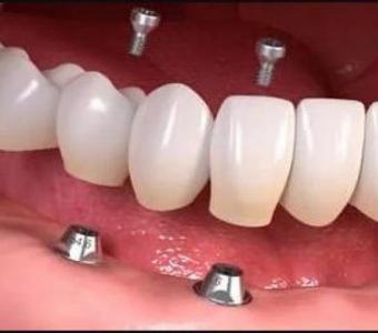 Same day crown Las Vegas by functionalaestheticdentistry.com