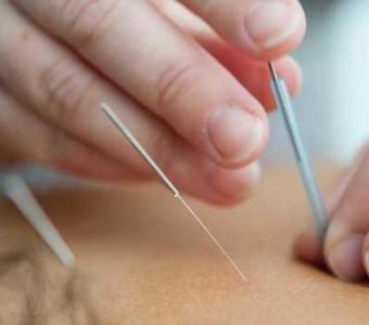 Relieve Pain with Expert Dry Needling Therapy in Denver