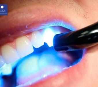 Best Teeth Whitening NJ: Brighten Your Smile Today!