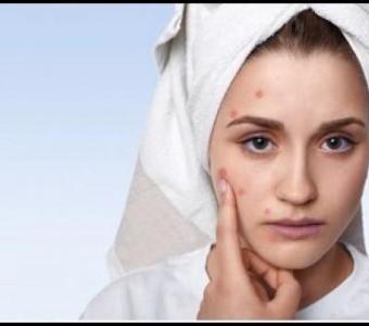 Ayurvedic treatment for Pimples in Ahmedabad