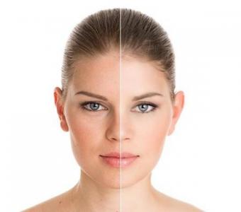 Pigmentation Treatment Delhi