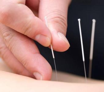 Acupuncture Therapy NYC