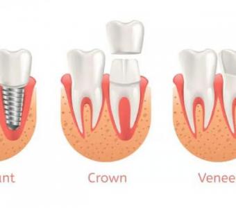 Experience Superior Dental Implant Solutions in Summerlin at Functional Aesthetic Dentistry