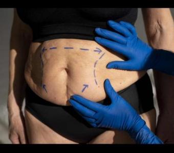 tummy tuck in ludhiana