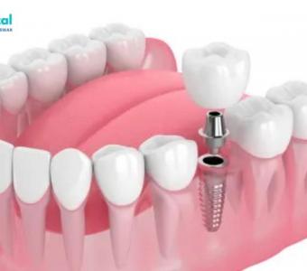 Discover the Best Dental Implants in Patia