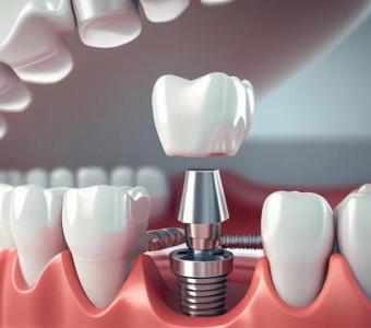 Which Health Conditions Affect Dental Implants in Richmond?