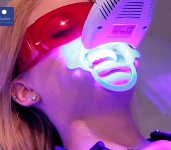 Top Benefits of Professional Teeth Whitening | Everbrite Teeth Whitening