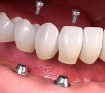 Experience Superior Dental Implant Solutions in Summerlin at Functional Aesthetic Dentistry