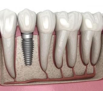 Top Dental Implant Clinics in Bhubaneswar – Schedule a Consultation