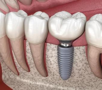 Top Dental Implant Clinics in Bhubaneswar – Schedule a Consultation