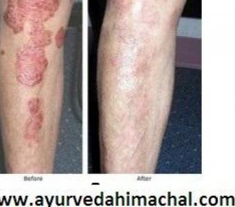 AROGYAM PURE HERBS KIT FOR PSORIASIS