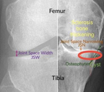 Knee Osteoarthritis London