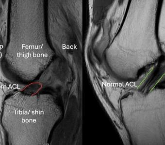 ACL Injuries London