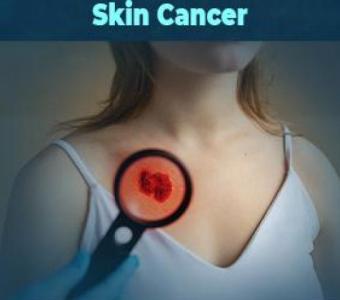 Best Skin Cancer Treatment Hospitals in Bangalore