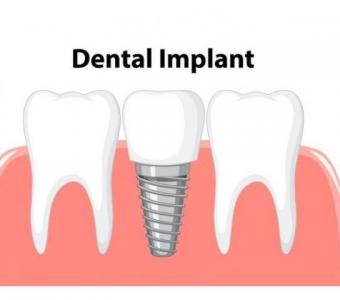 dental implant nehrunagar ahmedabad