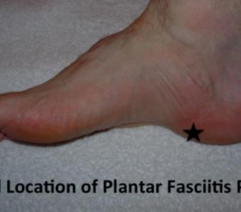 Plantar Fasciitis Heel Pain South Amboy