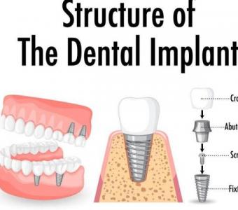 dental implant ambawadi ahmedabad